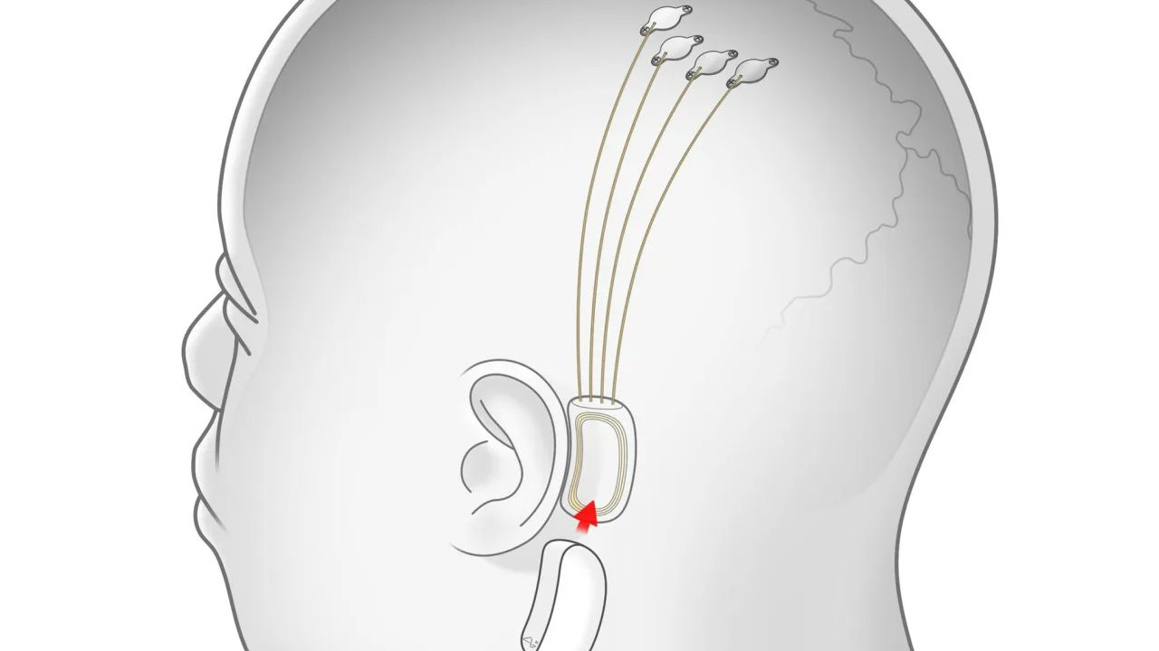 neuralink_elon musk (1)