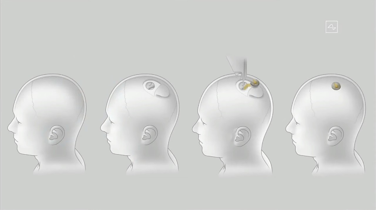 neuralink_cip implatacia_elon musk