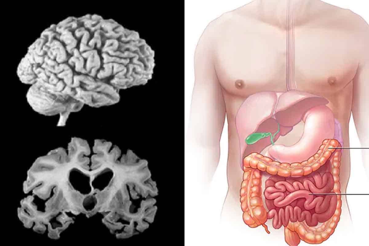 Alzheimerova choroba a poruchy tráviaceho traktu sú prepojené. Povedie to k liečbe?