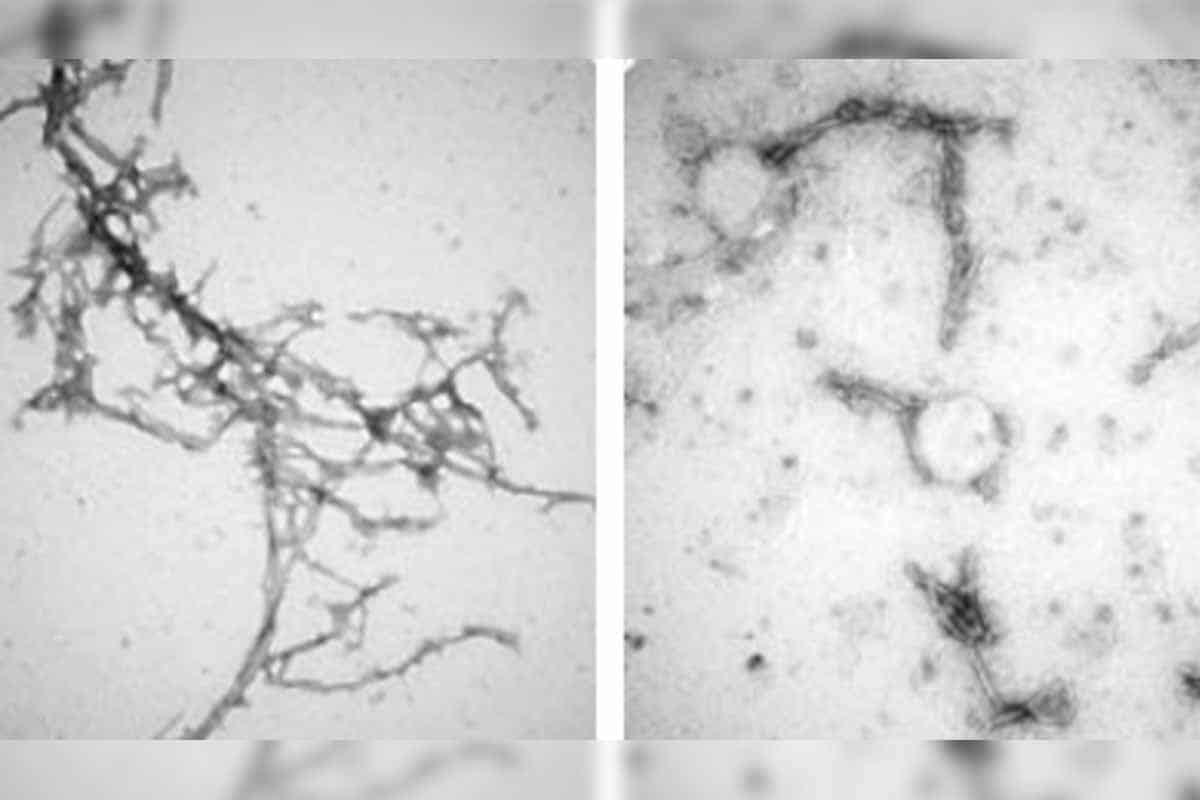 Našli vedci eso v boji proti Parkinsonovej chorobe?