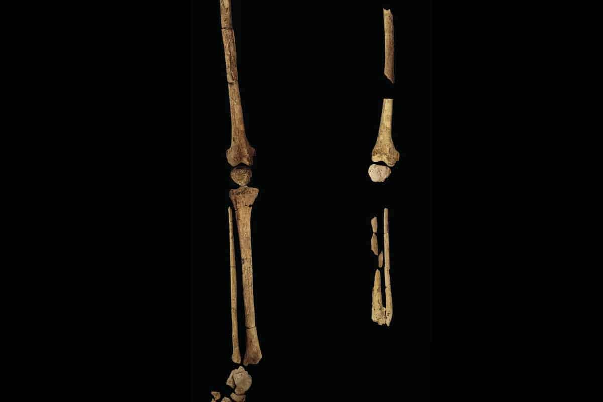 Prvá amputácia sa mohla udiať oveľa skôr, než archeológovia predpokladali. 