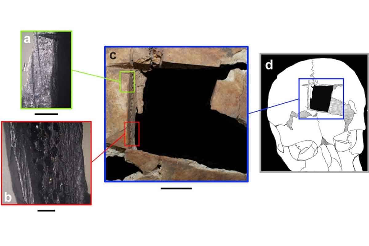 Archeológovvia objavili najstarší prípad trepanácie na blízkom východe