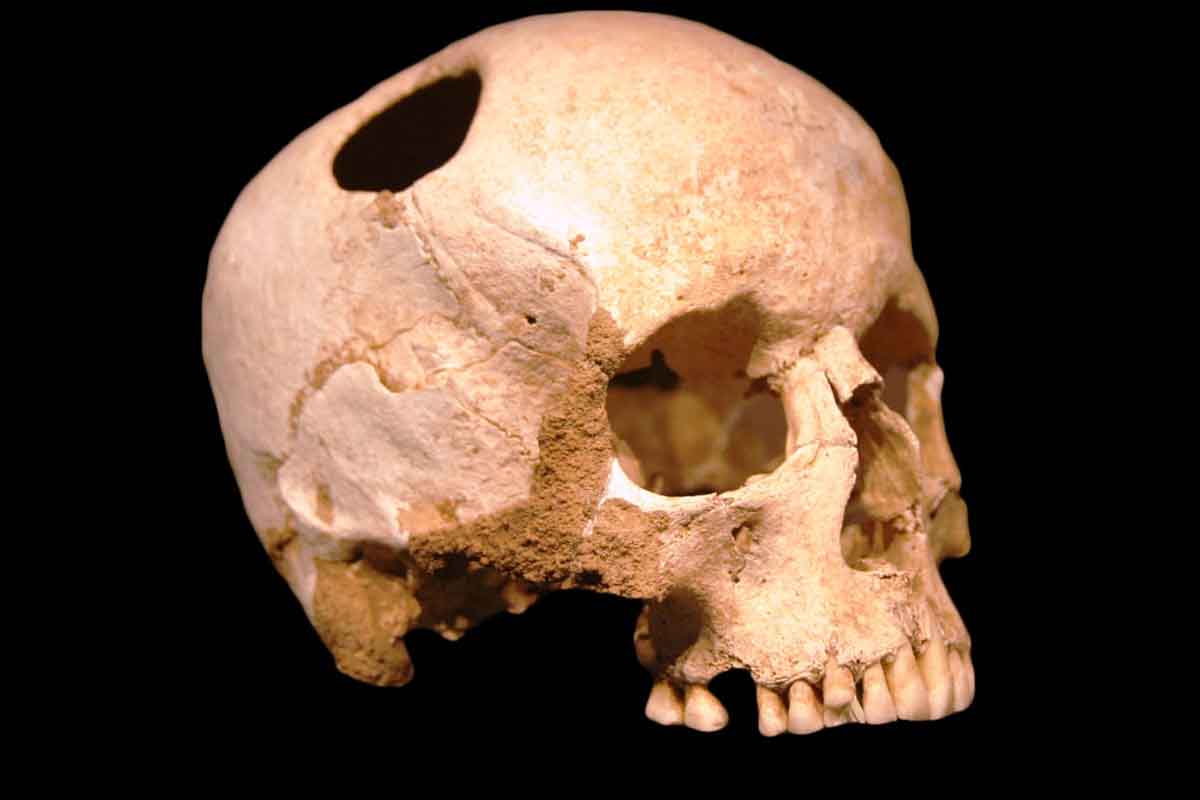 Archeológovvia objavili najstarší prípad trepanácie na blízkom východe