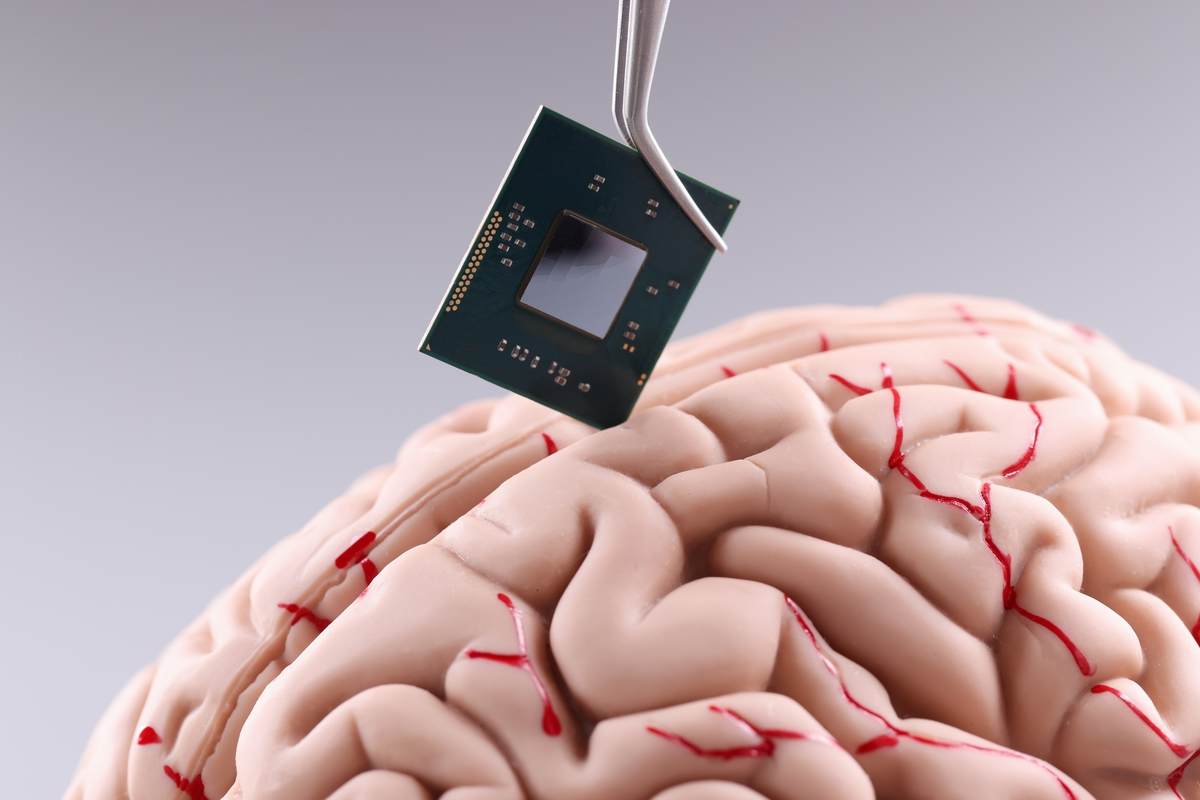 cip mozog implantat