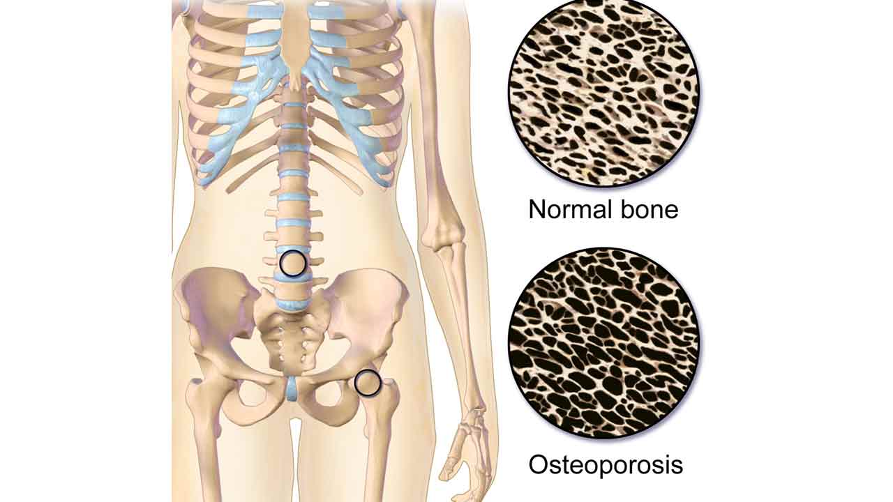 Výskumníci našli spôsob, ako poraziť osteoporózu