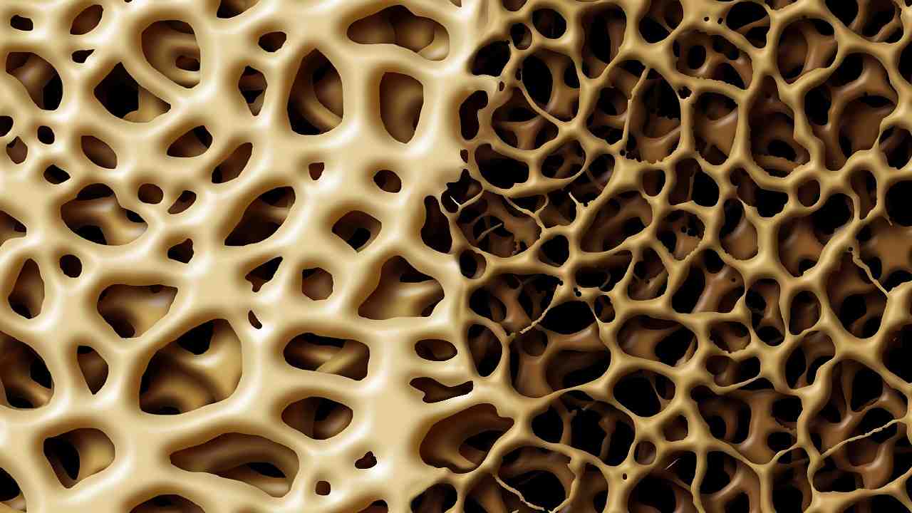 slabe kosti osteoporoza_1