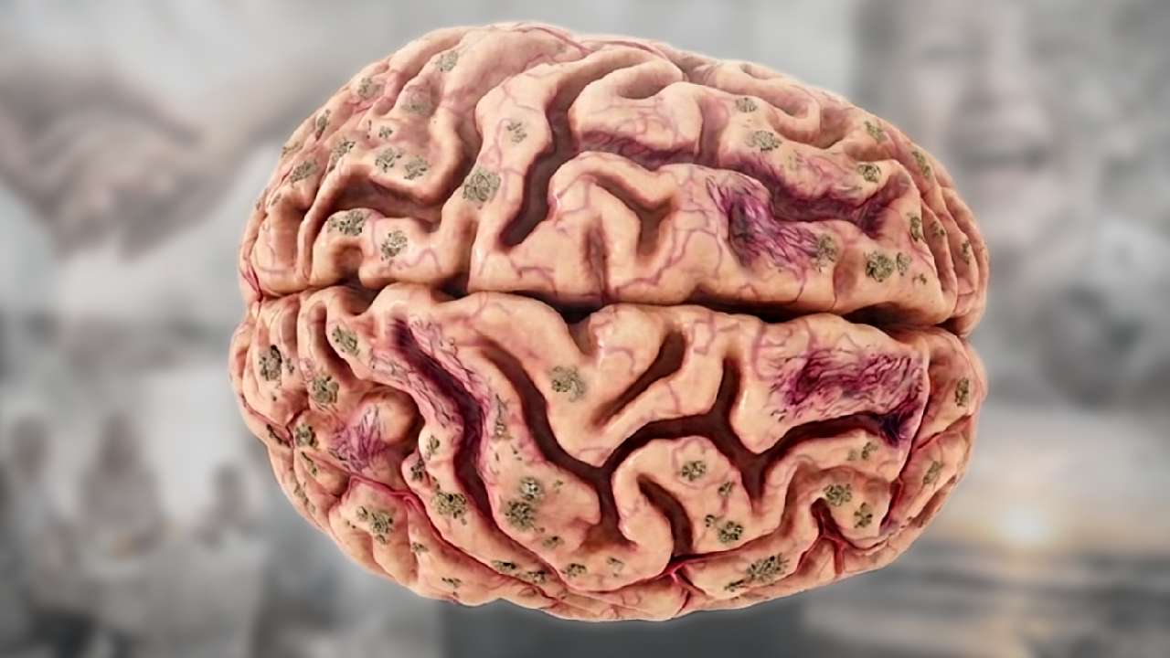 Alzheimerova choroba