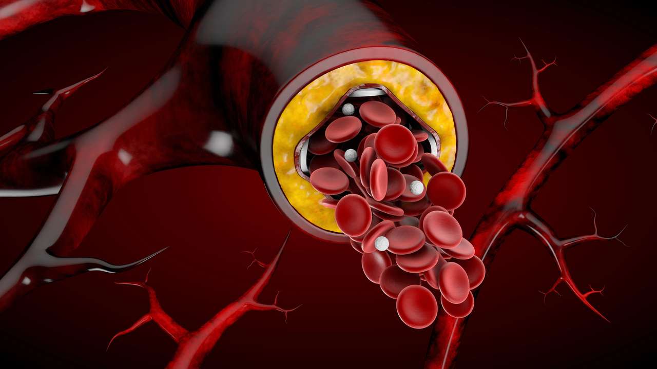 krv cholesterol zila cievy